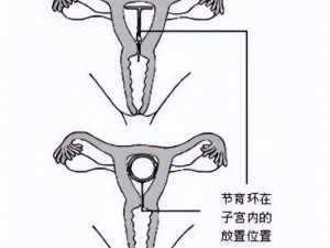 节育环放置位置图解：深入了解节育环在子宫内的安放位置与影响