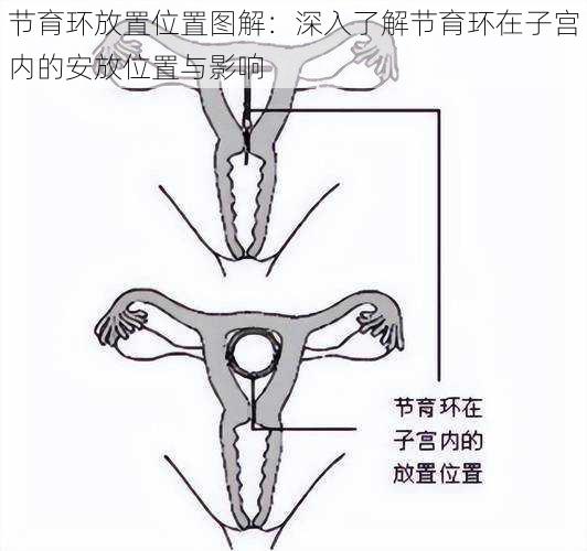 节育环放置位置图解：深入了解节育环在子宫内的安放位置与影响